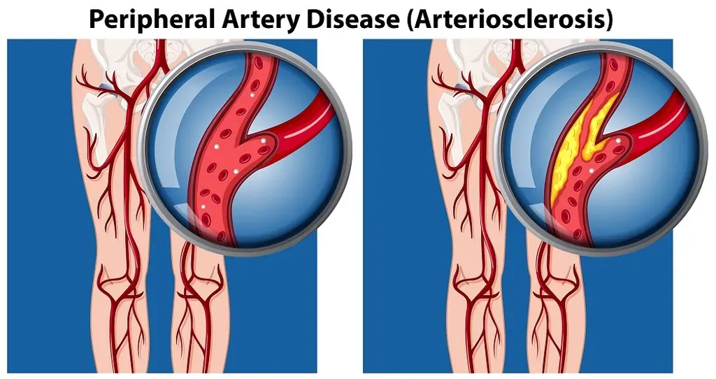 Understanding Your Peripheral Artery Disease Diagnosis | Vascular ...