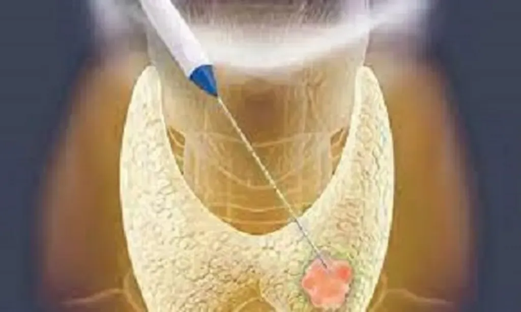 Radiofrequency Ablation (RFA) of Thyroid Nodules | Interventional ...