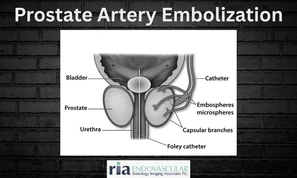 A Minimally Invasive Solution for BPH | Interventional Radiology ...