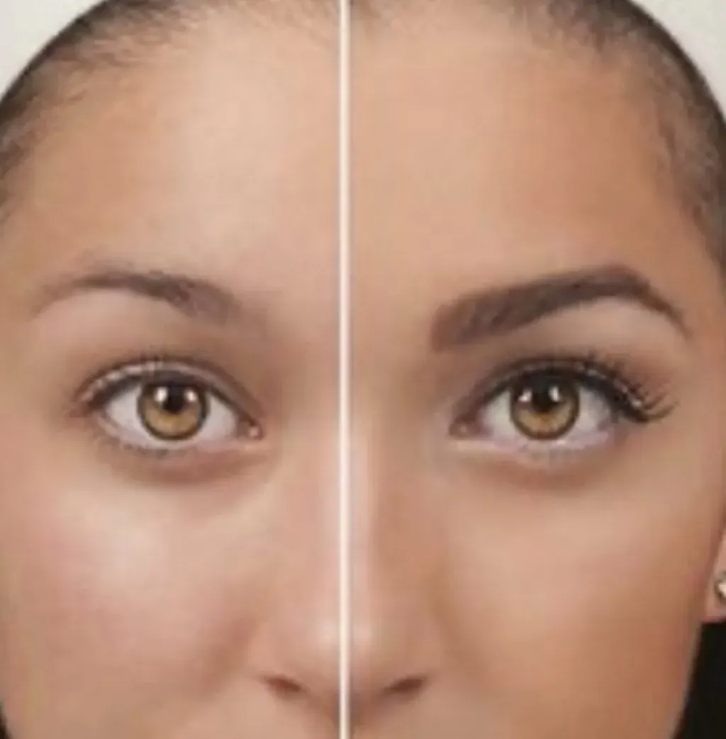 Female and Male Eyebrow Hair Transplant | Hair Restoration Specialists ...