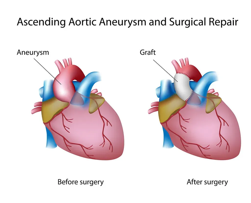 Aortic Root Reconstruction | Heartplace | Cardiovascular Disease ...