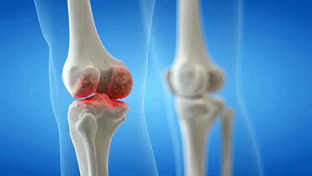 Bone Infections for Richardson, TX | Texas Infectious Disease Institute ...