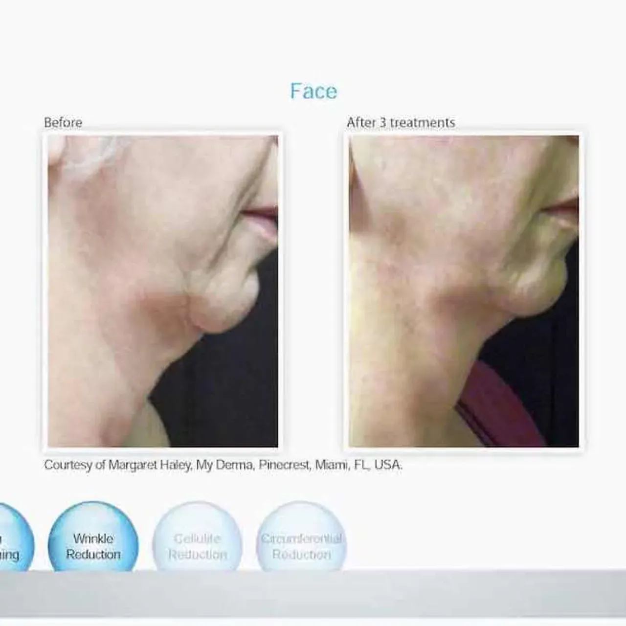 Venus Freeze for Manhattan Beach, Brooklyn, NY | Levit Dermatology ...