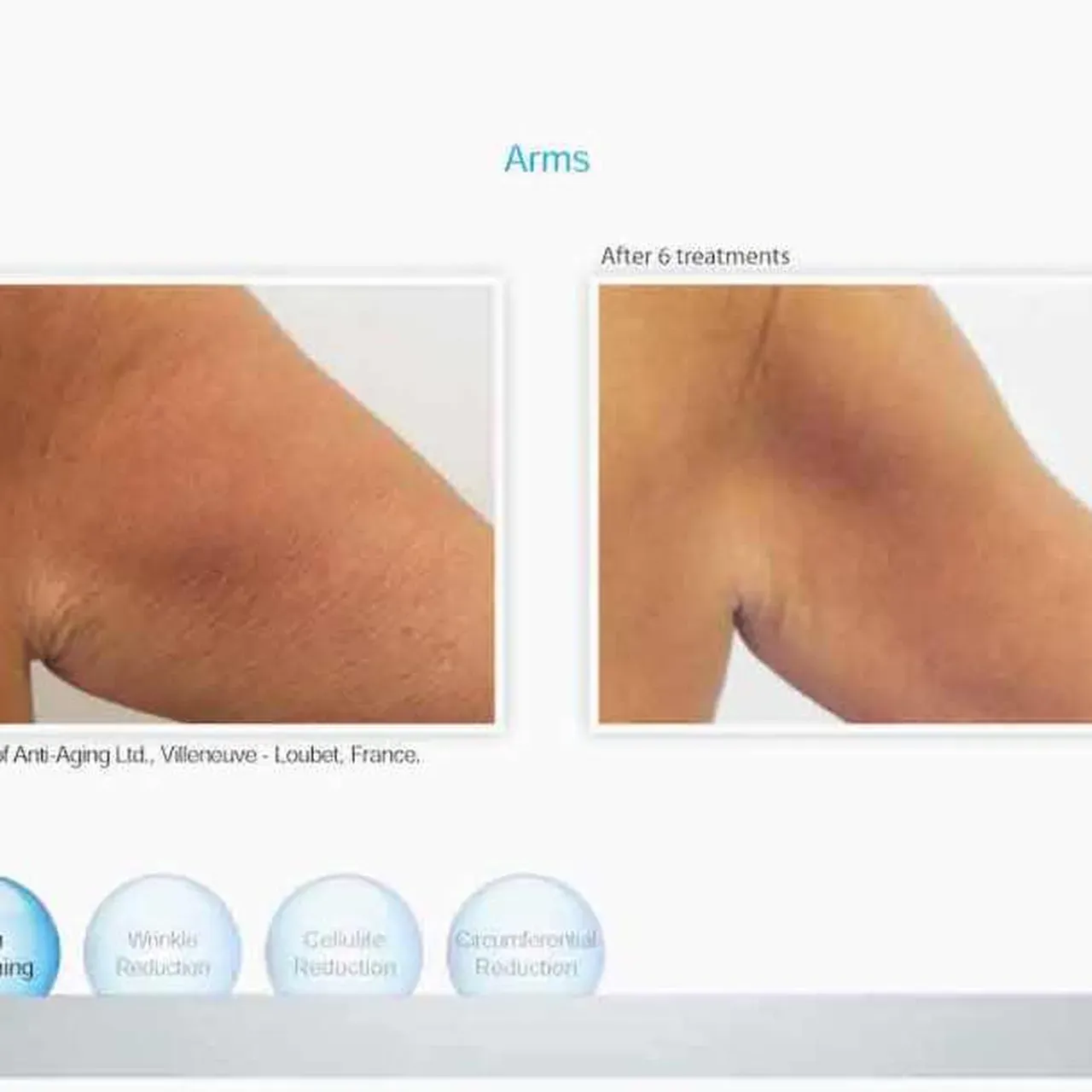 Venus Freeze for Manhattan Beach, Brooklyn, NY | Levit Dermatology ...