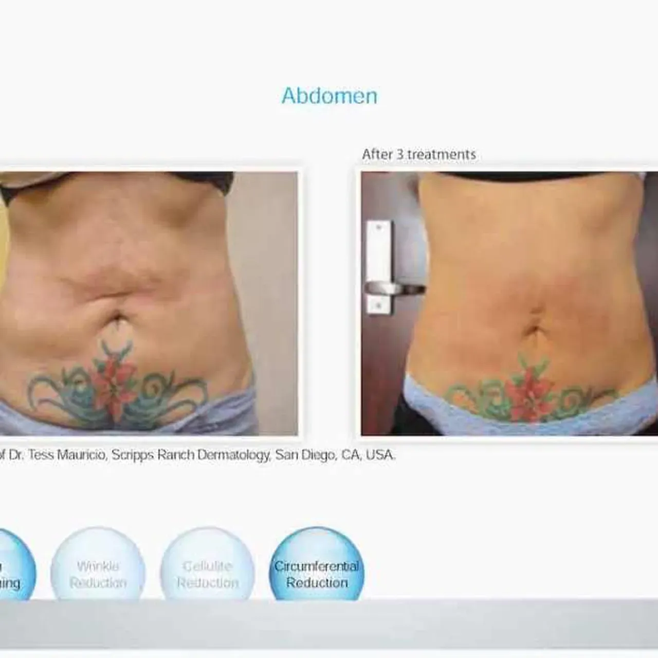 Venus Freeze for Manhattan Beach, Brooklyn, NY | Levit Dermatology ...
