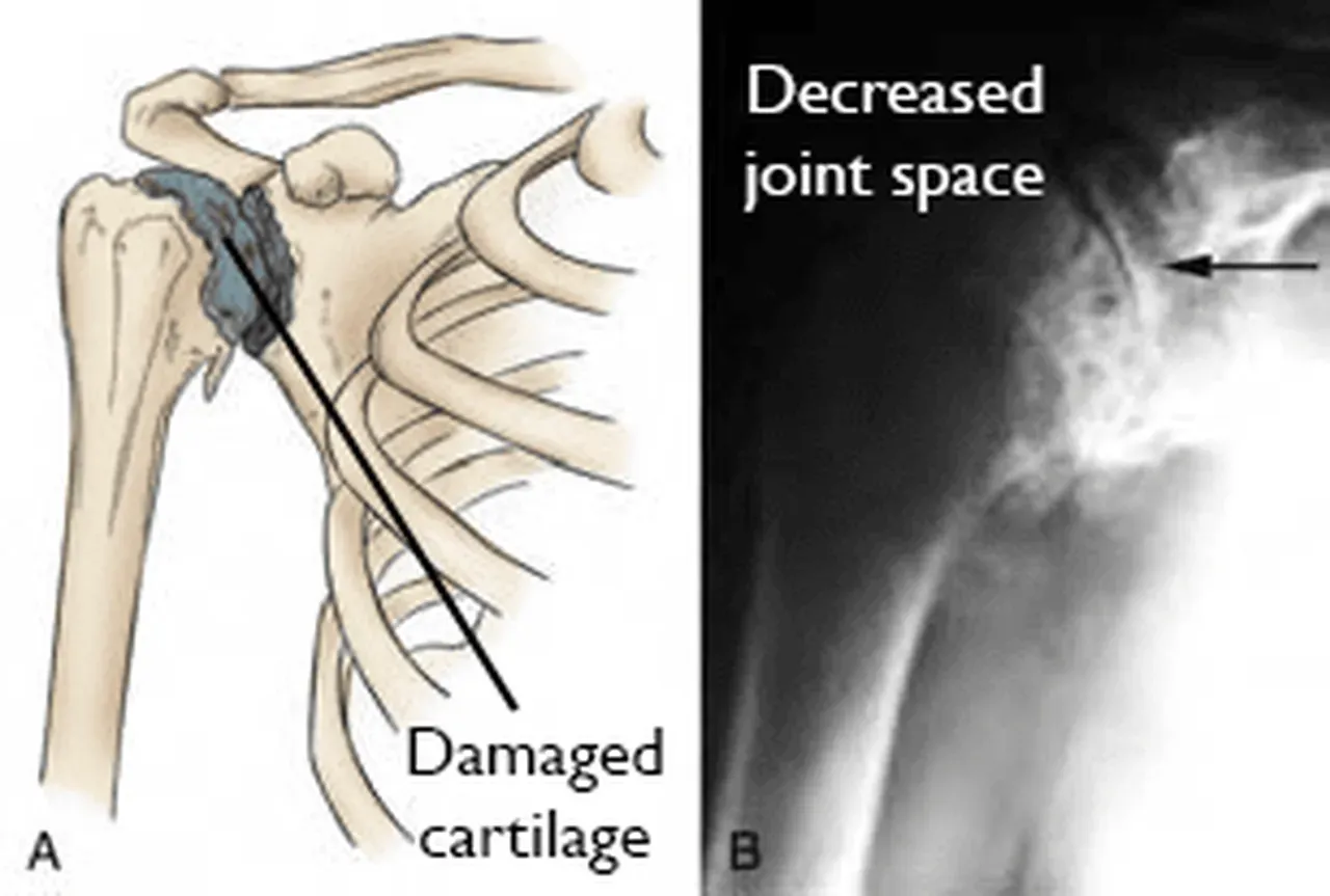 Shoulder Replacement - Naples, FL: Restoration Orthopedics: Orthopedic ...