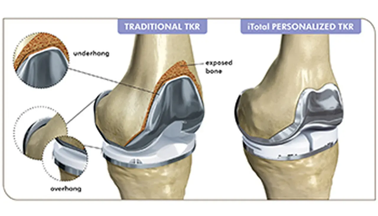 ConforMIS Personalized Total Knee Implants | Orthopedic Surgery & Joint ...