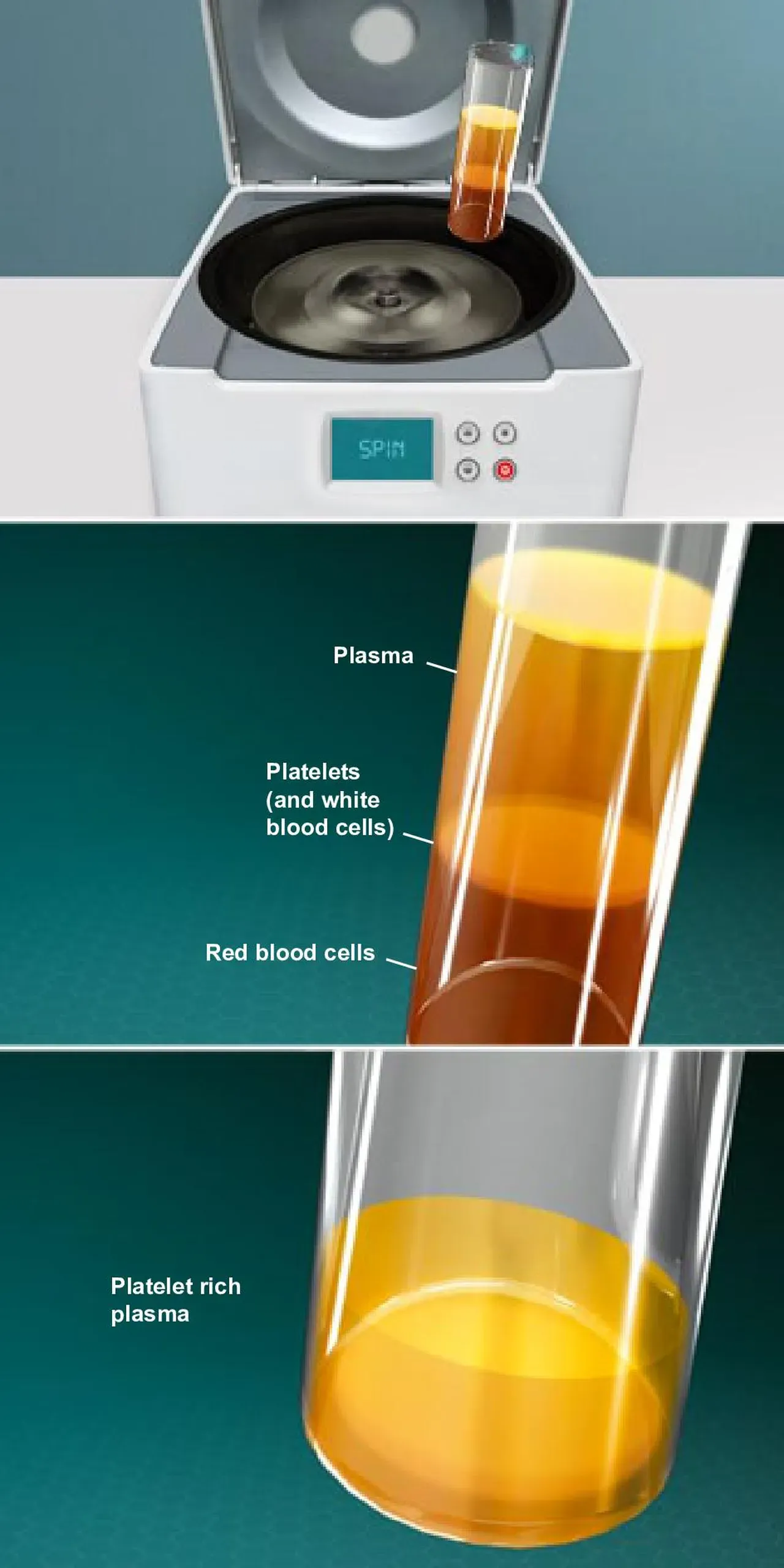 Platelet Rich Plasma (PRP) Injection Overview | Orthopedic Surgery ...