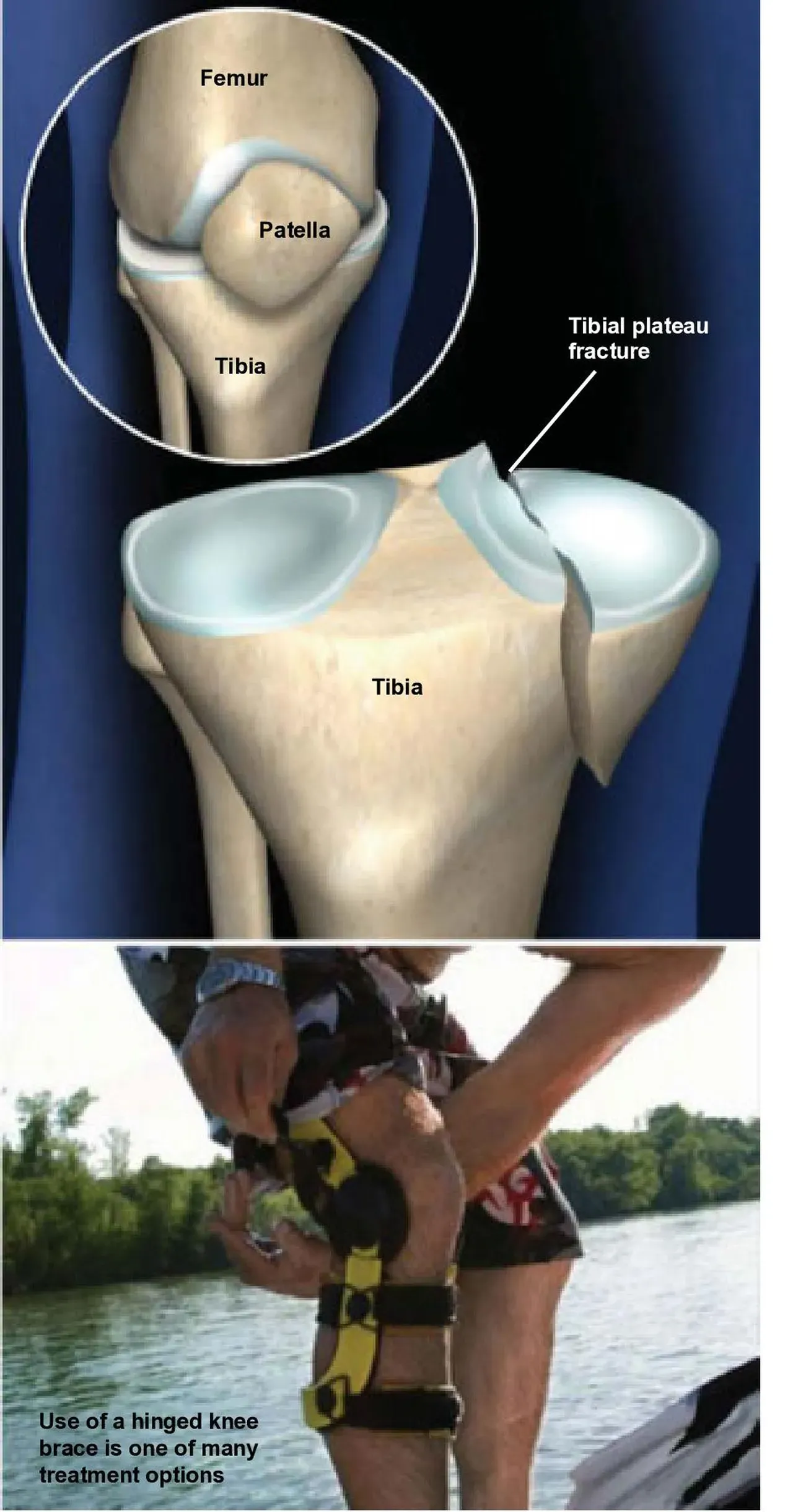 Tibial Plateau Fracture | Orthopedic Surgery & Joint Replacement ...