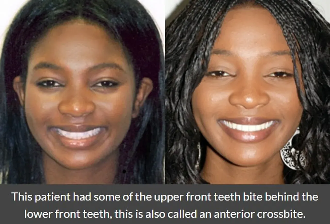 Invisalign® Before and After | Family and Cosmetic Dentistry located in ...