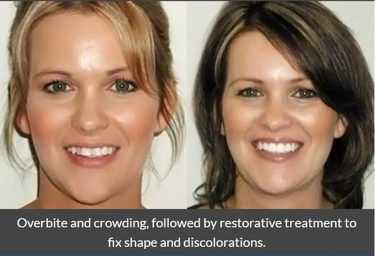 Invisalign® Before and After | Family and Cosmetic Dentistry located in ...
