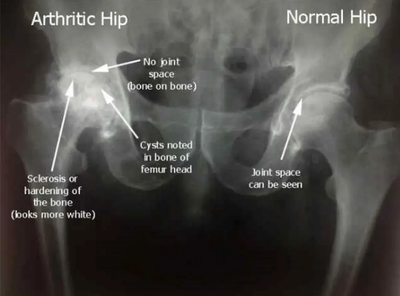 Hip Arthritis (Osteoarthritis) | Orthopaedics located in Albany, GA ...