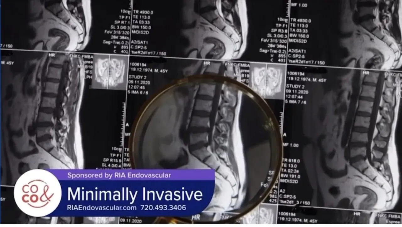 Tony Brown, MD, on Why Minimally Invasive and Why RIA Endovascular ...