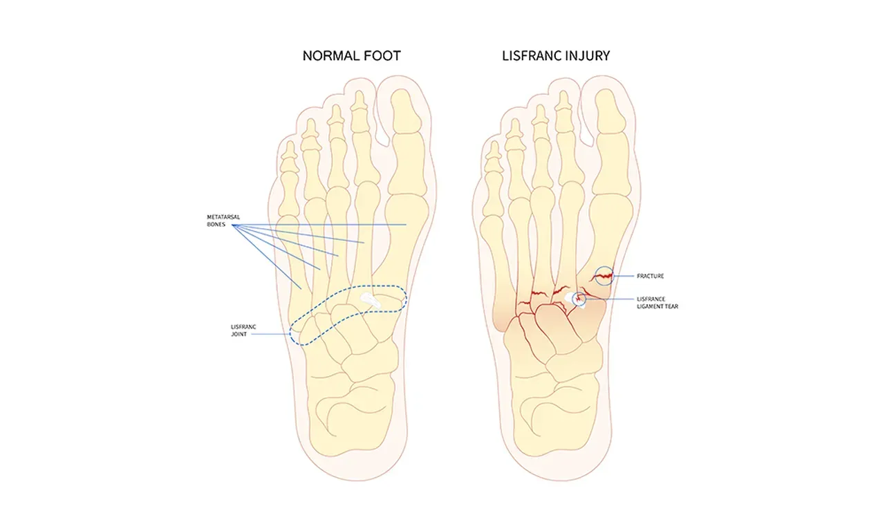 Lisfranc Injuries: Causes, Treatments, and Rehabilitation | Podiatry ...