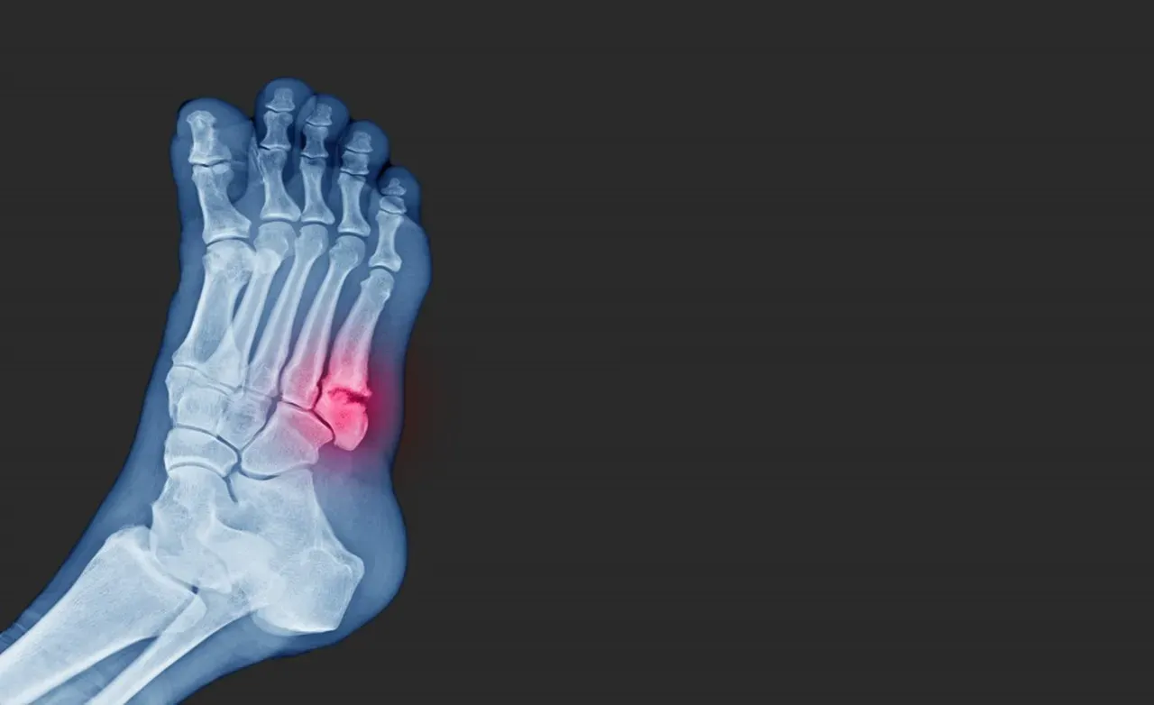 Understanding Jones Fractures: Why Surgery is Typically Indicated ...