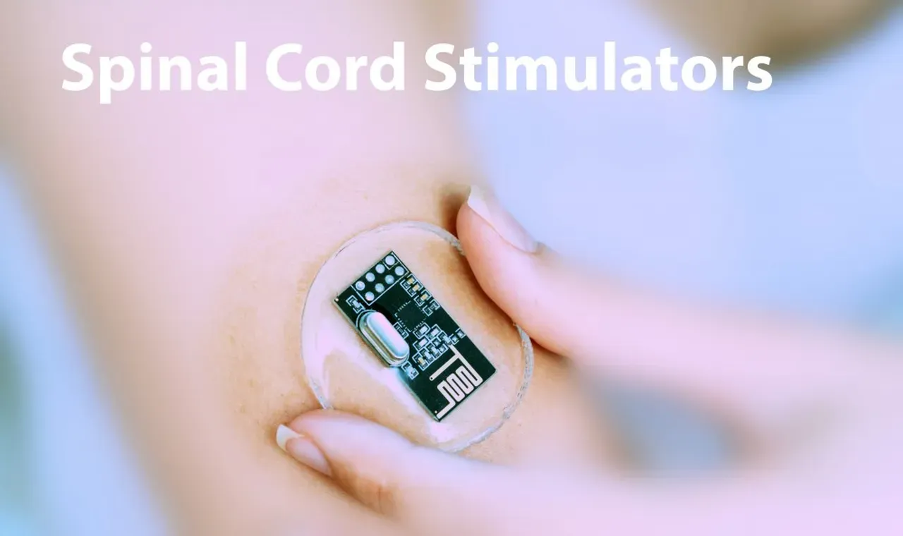 How Does a Spinal Cord Stimulator Trial Work? | Board Certified ...