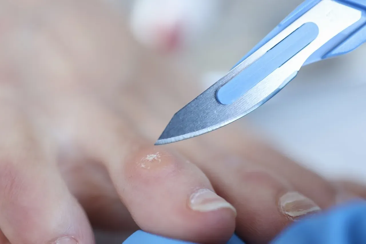 Corn Removal Surgery: When Do You Need It? | Podiatrist located in ...