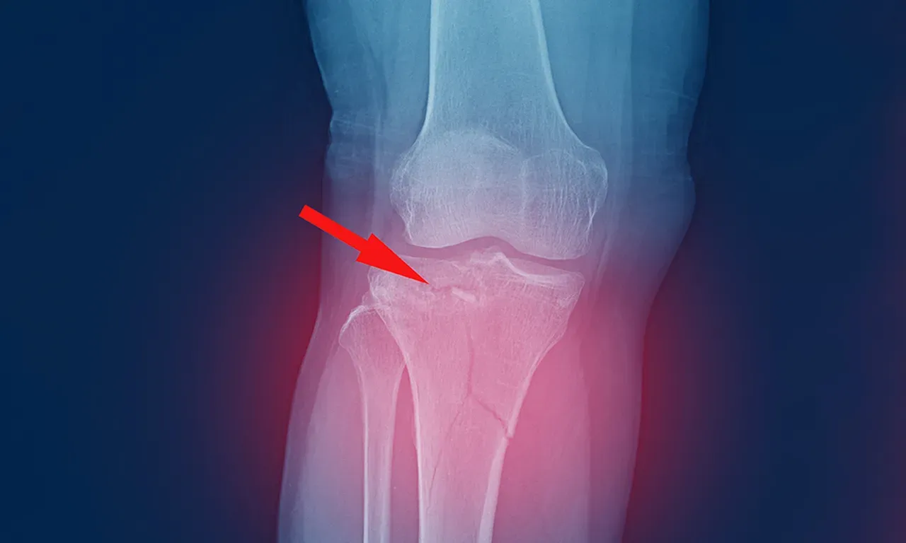 Ankle Sprains for Austin and Bee Cave, TX | Austin Foot & Ankle ...
