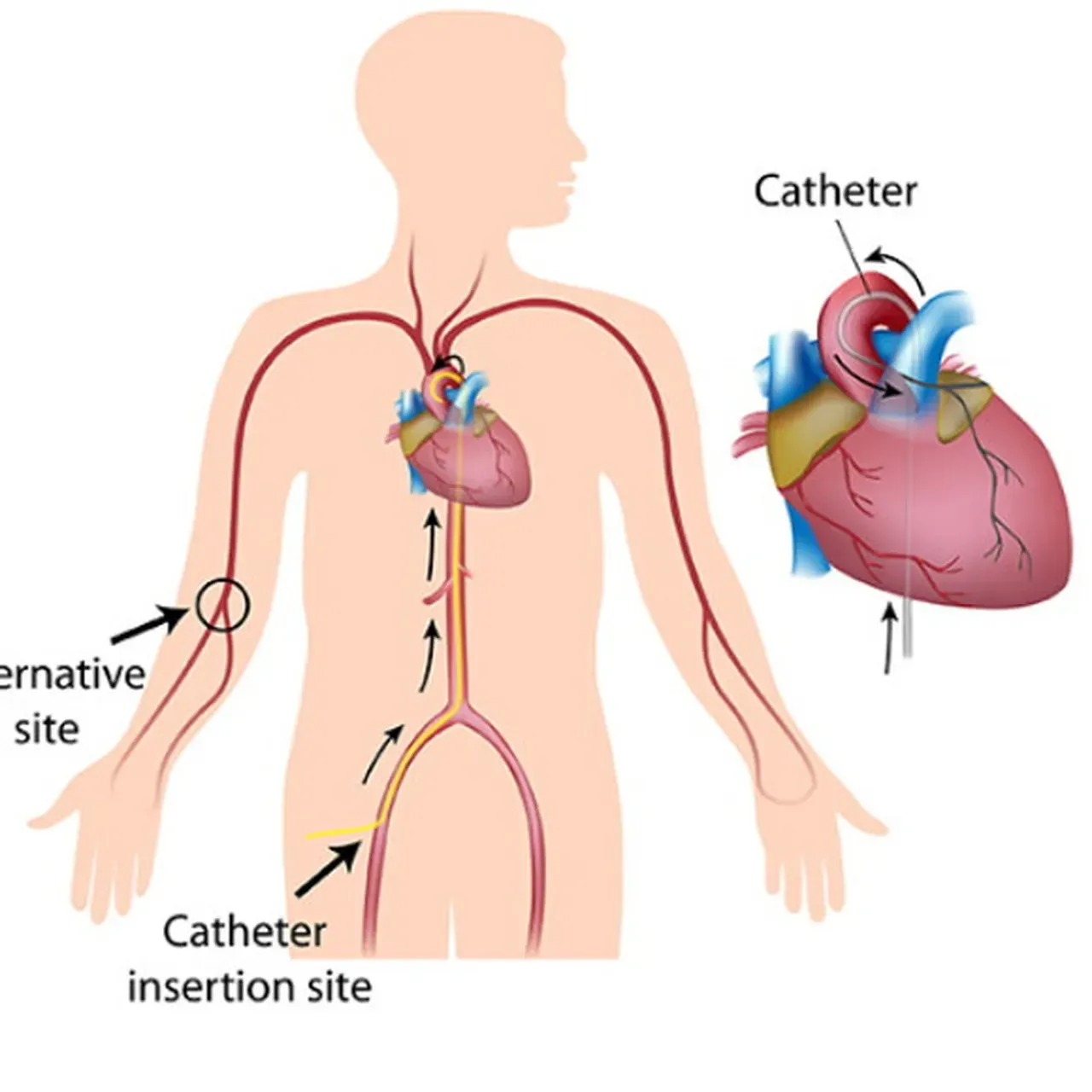 Cardiac Catherization | Heartplace | Cardiovascular Disease Specialists ...
