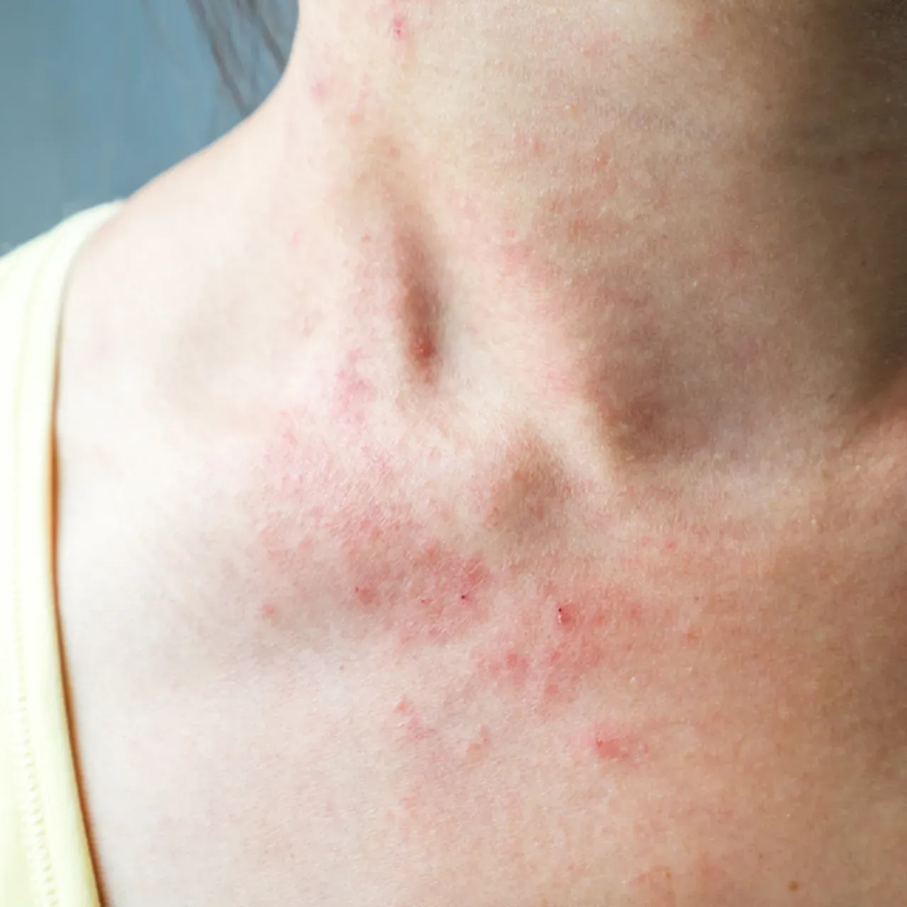 Rashes for Bluefield, Radford and Wytheville, VA and Beckley, Princeton ...