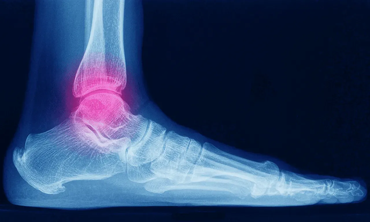 Ankle Sprains for Austin, Bee Cave, Cedar Park and Pflugerville, TX ...