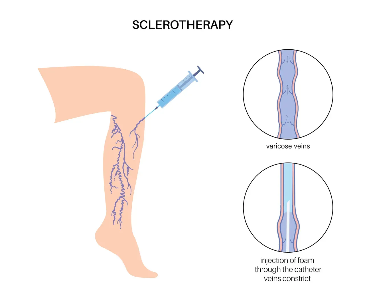 Sclerotherapy for Hobart, LaPorte, Munster, Valparaiso and Merrillville ...