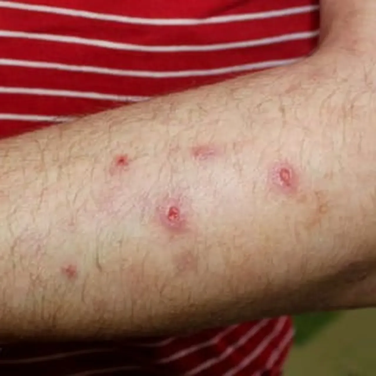 Prurigo Nodularis | Dermatologists located in Fairfax, VA | Integrated ...