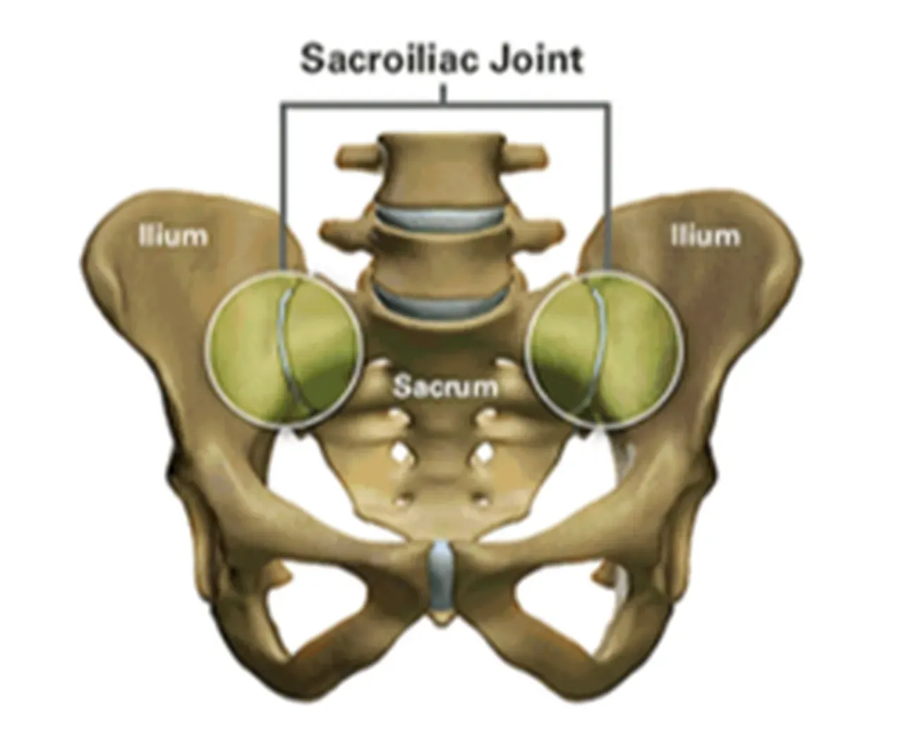 Sacroiliac (SI) Joint Fusion - Garden City, NY: Benjamin R. Cohen, M.D ...