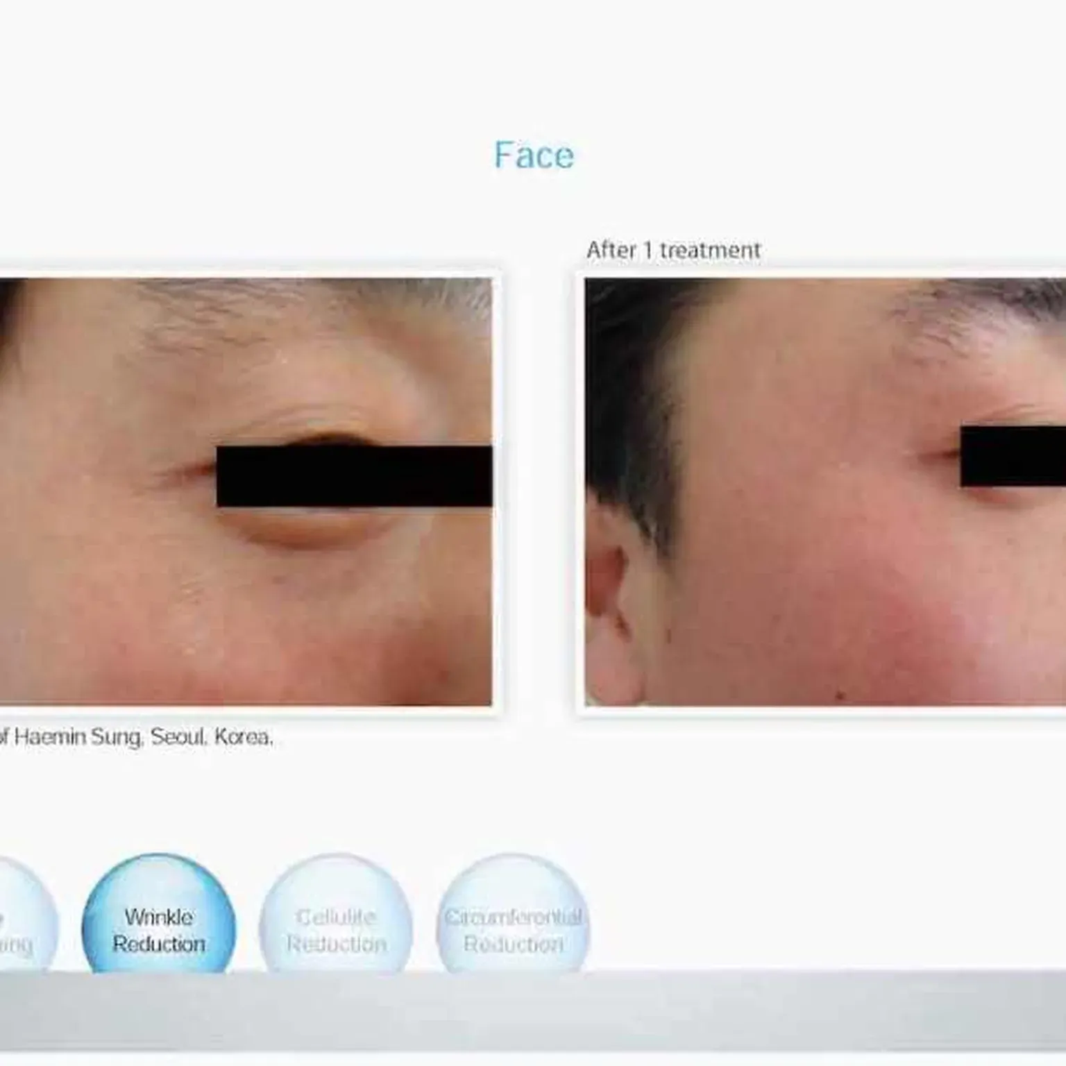 Venus Freeze for Manhattan Beach, Brooklyn, NY | Levit Dermatology ...