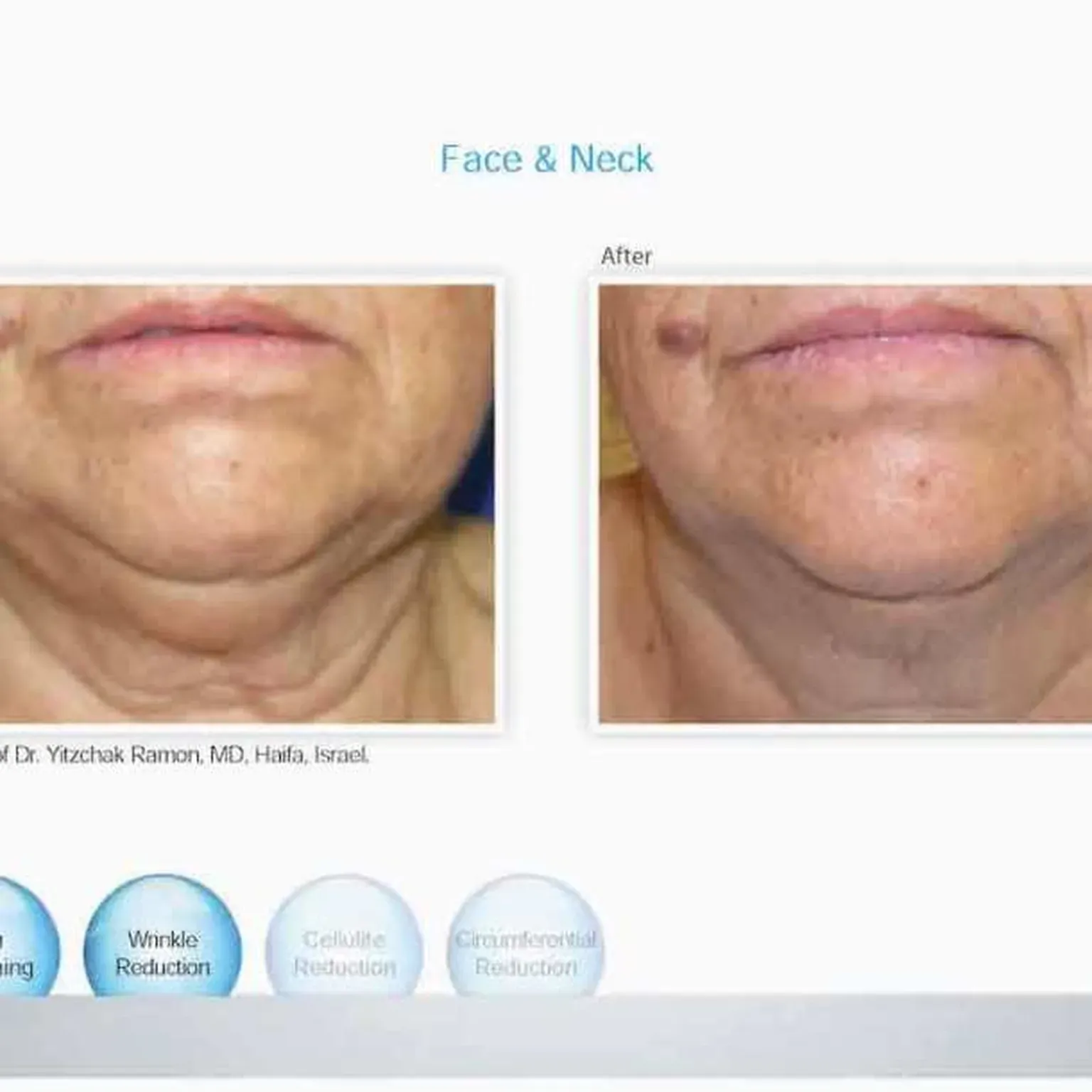 Venus Freeze for Manhattan Beach, Brooklyn, NY | Levit Dermatology ...