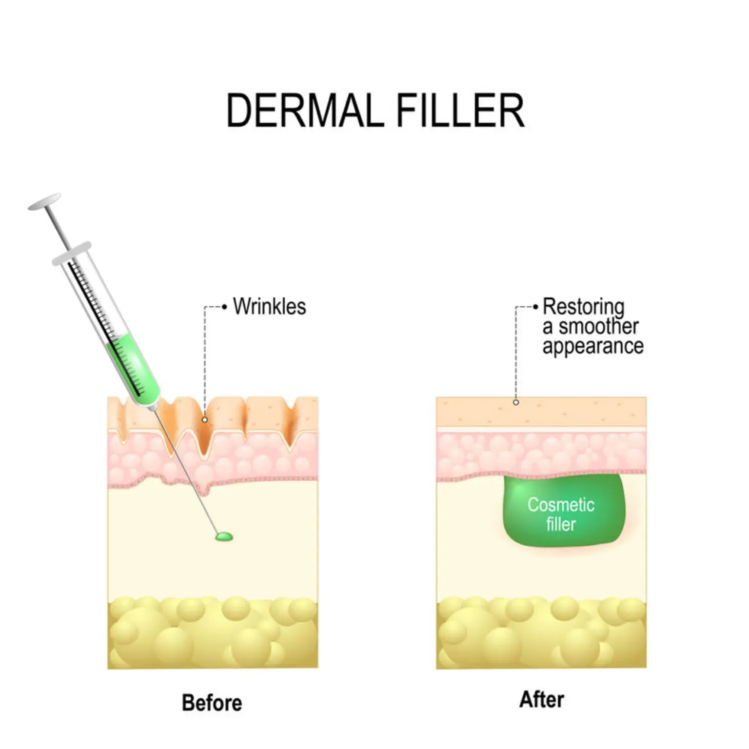 What Do Fillers Do Under the Skin? | Board Certified Dermatologists ...