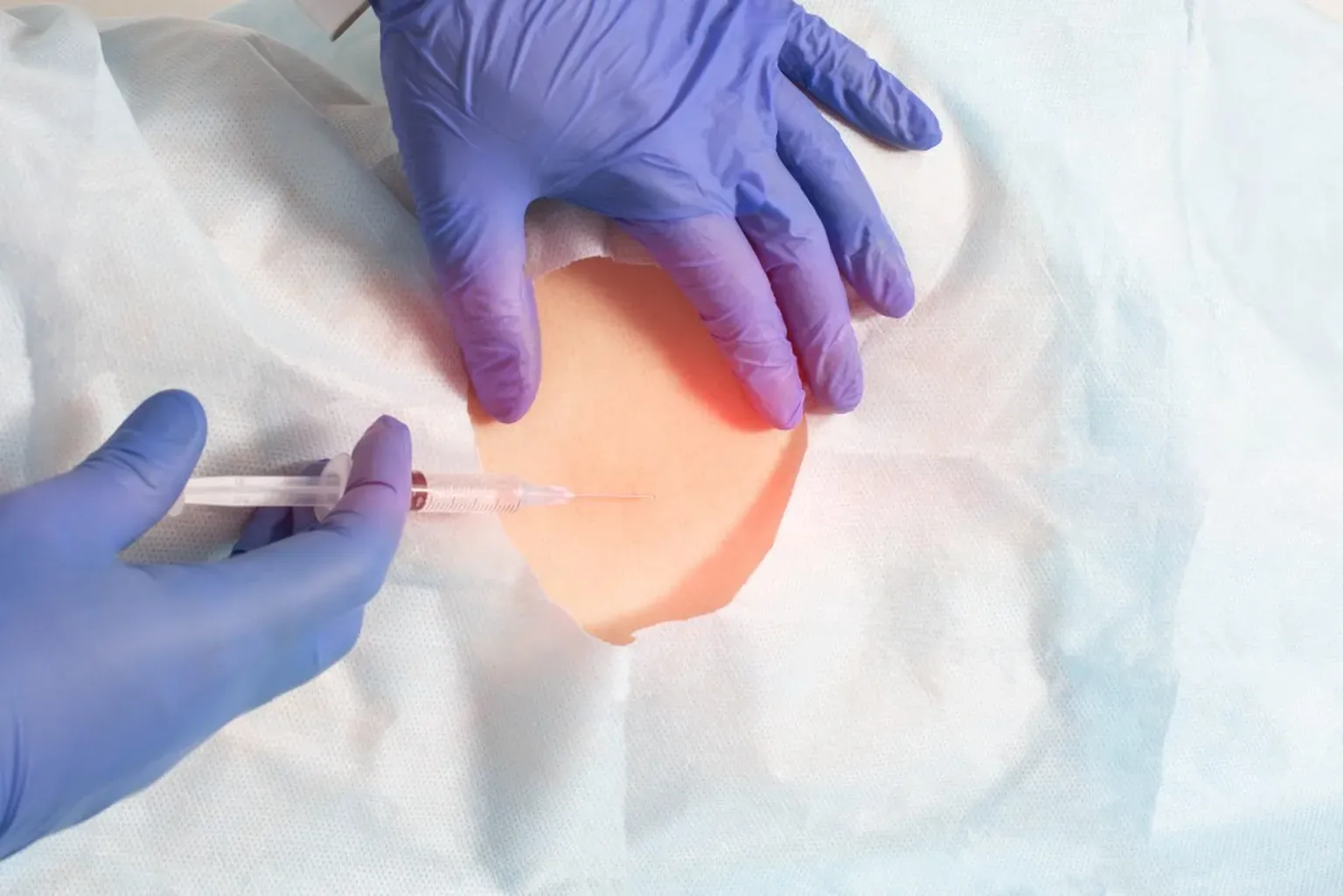 Are Epidural Steroid Injections Safe? | Neurology, Neurosurgery ...