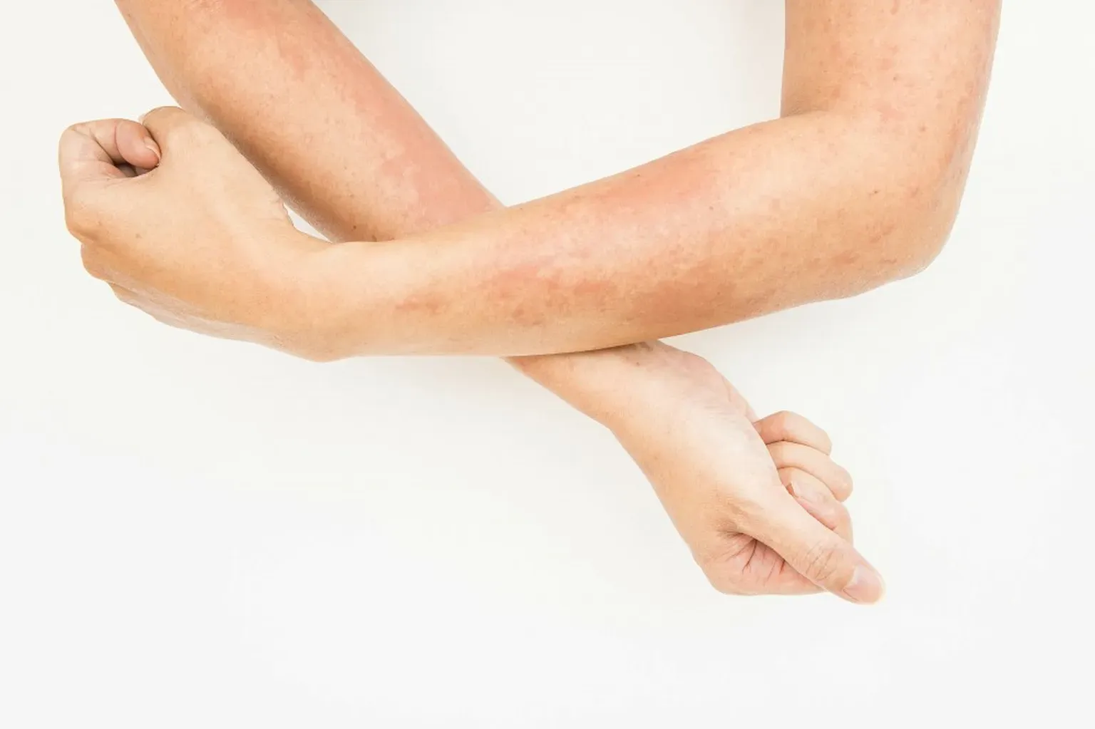 How to Identify and Treat Contact Dermatitis Fast | Allergy ...