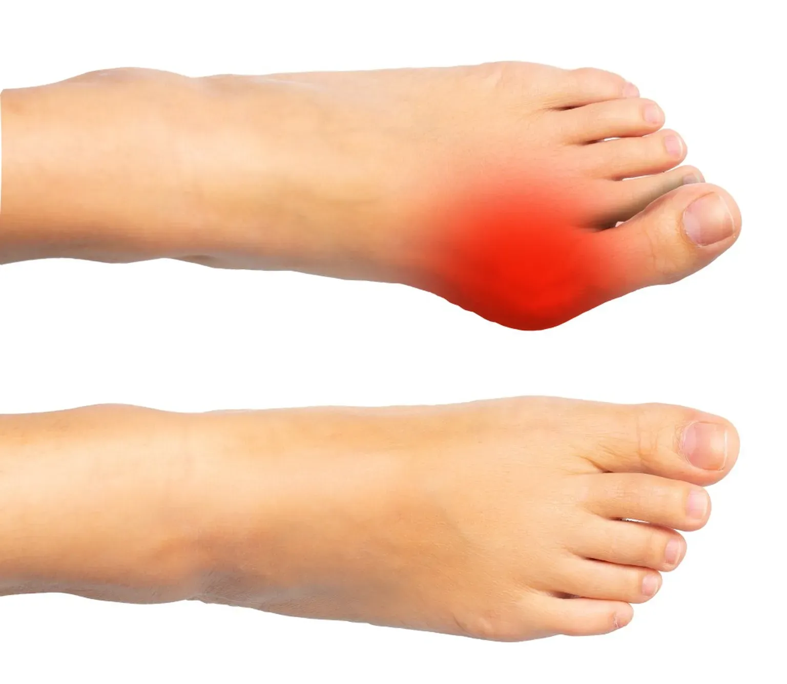 Is It a Bunion? Understanding the Signs and Symptoms | Foot and Ankle ...