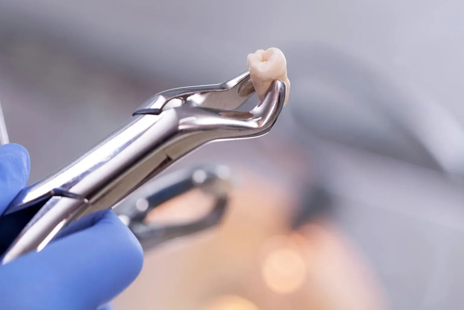 Tooth Extraction for Fairfax, Alexandria and Woodbridge, VA | Nova ...