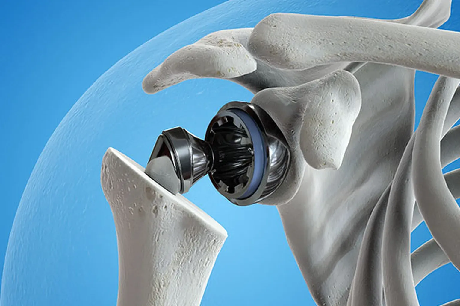 Total Shoulder Replacement for Austin, Bee Cave, Cedar Park and ...
