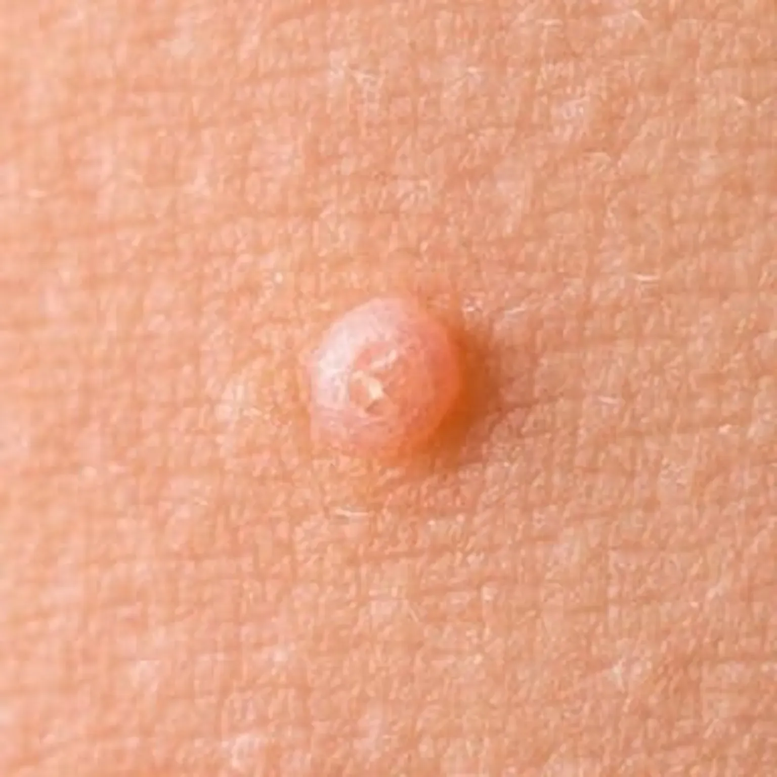 Molluscum Contagiosum | Dermatologists located in Fairfax, VA ...