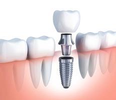 Dental Implants