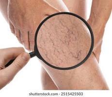 Sclerotherapy