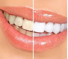 Teeth Whitening