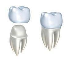 Dental Crowns
