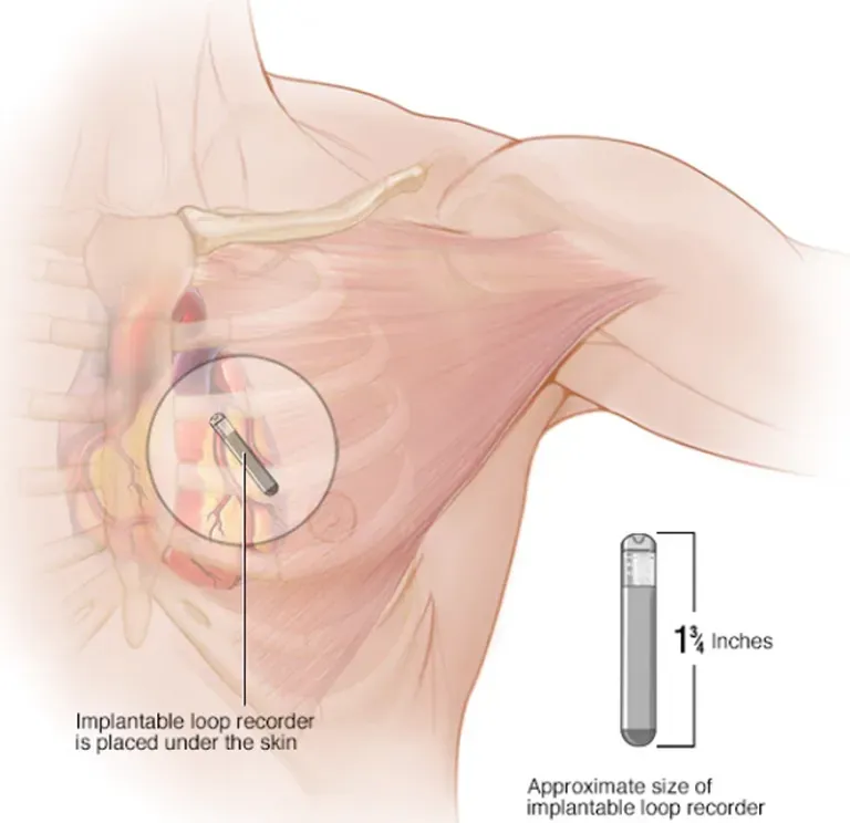 Implantable Loop Recorder | Heartplace | Cardiovascular Disease ...