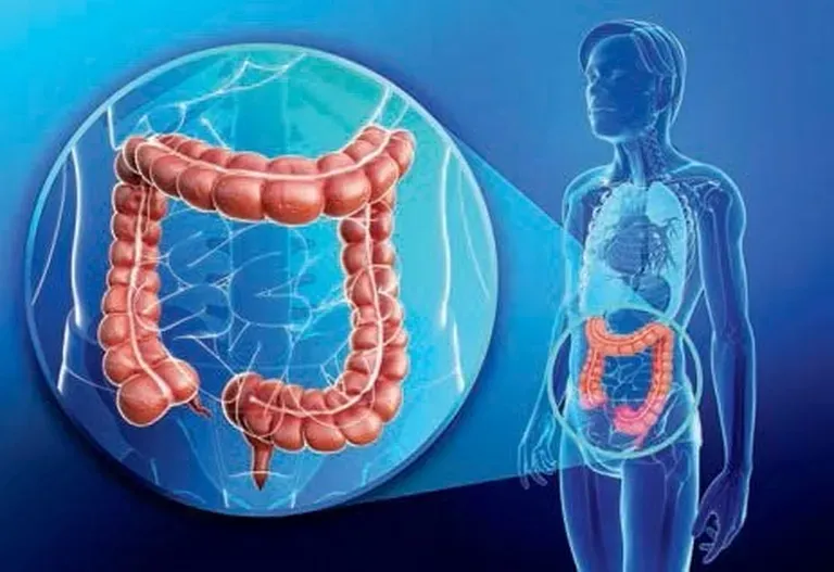 Understanding Colon Polyps And Their Treatment | Gastroenterology ...