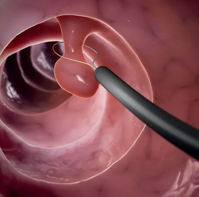 Understanding Colon Polyps And Their Treatment | Gastroenterology ...