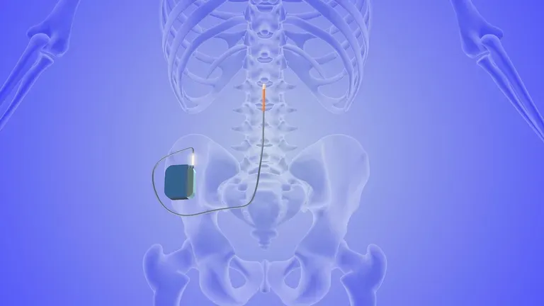 Spinal Cord Stimulator for Berlin, MD and Millville, DE | Dr. Zaky ...