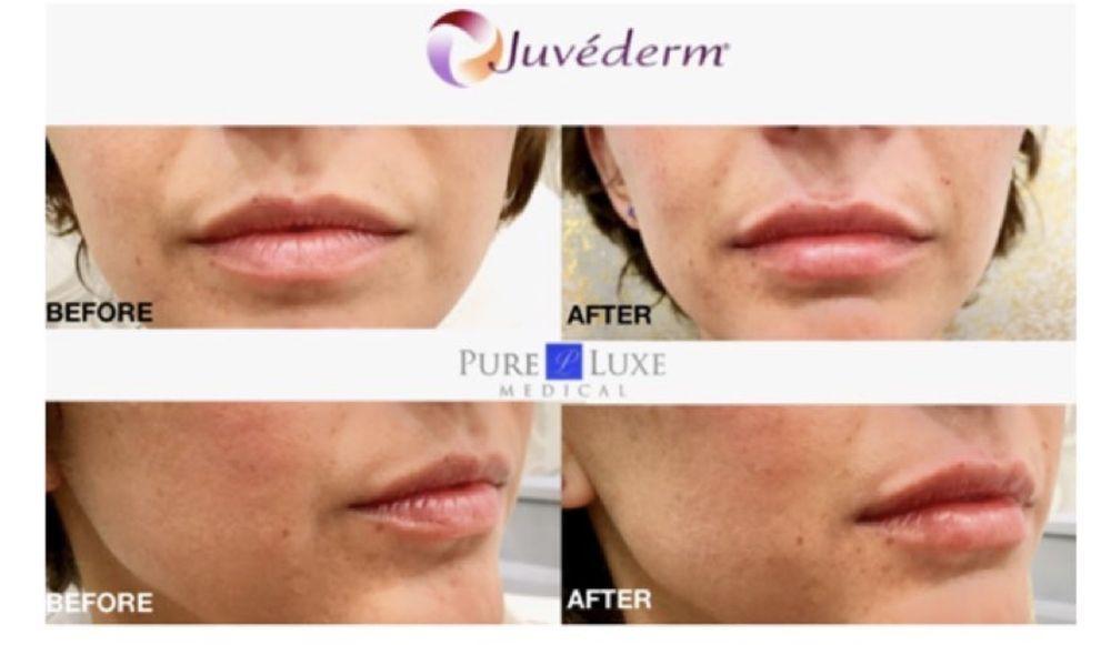 Botox/Juvederm Gallery - El Segundo, CA: Pure Luxe Medical