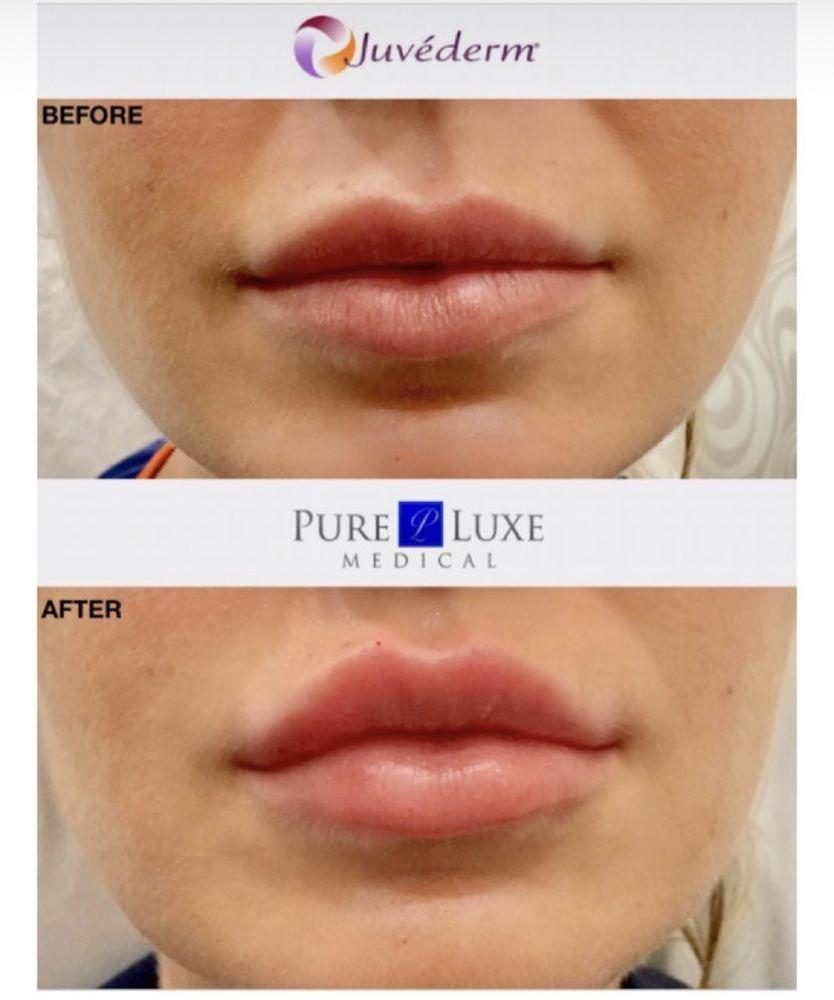 Botox/Juvederm Gallery - El Segundo, CA: Pure Luxe Medical