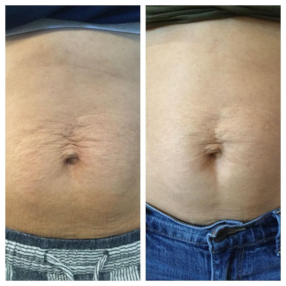 Ultherapy abdominal skin treatment image 2