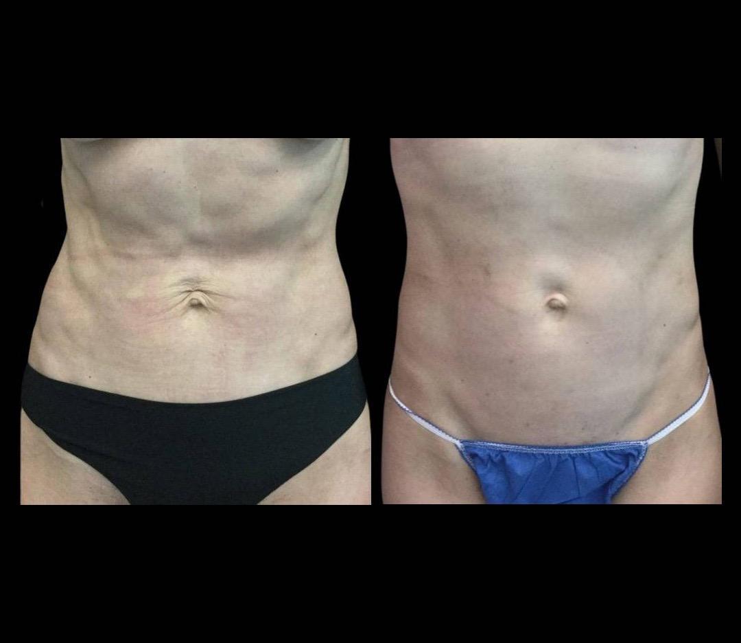 Ultherapy abdominal skin treatment image 1