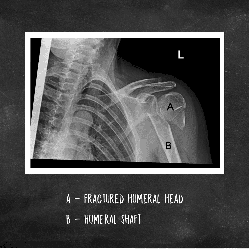 Terminal J Sign J Sign Knie , What is the J-sign and why is it important? – UTFJNN